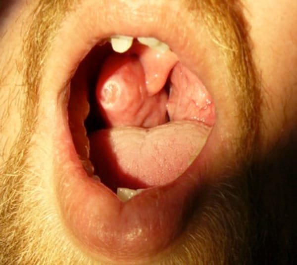 Snoring and sleep apnoea in adults — clinical image 1