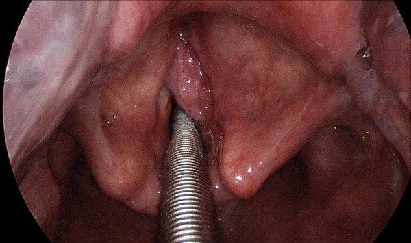 Hoarseness and voice problems — clinical image 1