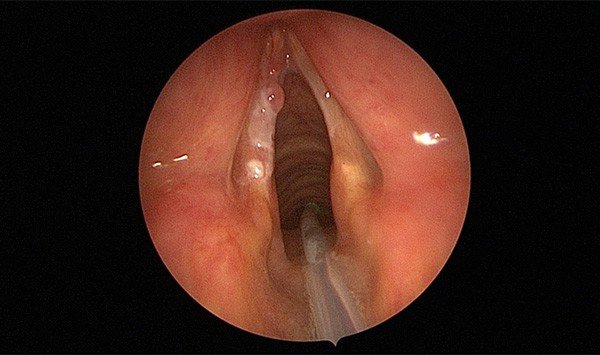 Hoarseness and voice problems — clinical image 1