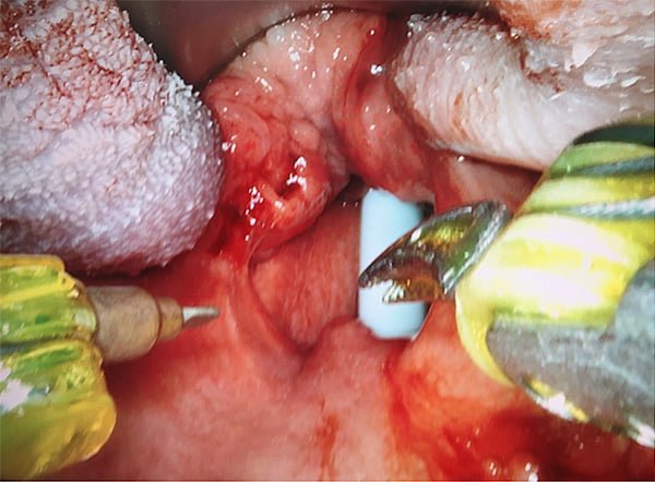 HPV and throat cancer — clinical image 1