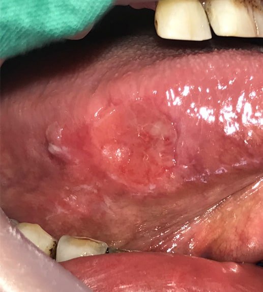 Mouth pain and oral lesions — clinical image 1