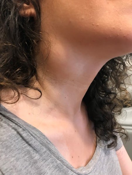 Neck lump — clinical image 1