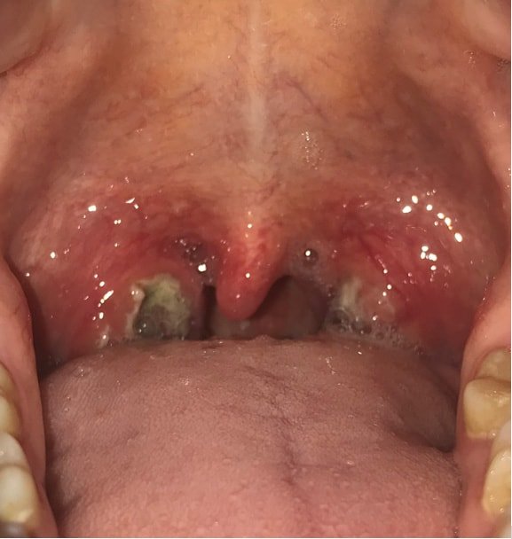 Tonsil and adenoid problems — clinical image 1